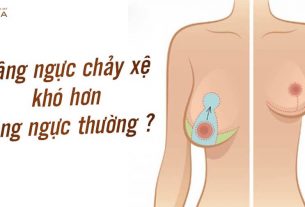 Nâng ngực chảy xệ - Phương pháp cứu bầu ngực U40 - Nangngucxe.vn