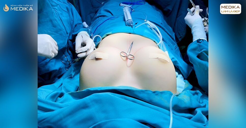 MEDIKA phẫu thuật nâng vòng 1 an toàn với phương pháp nội soi - Nangngucxe.vn