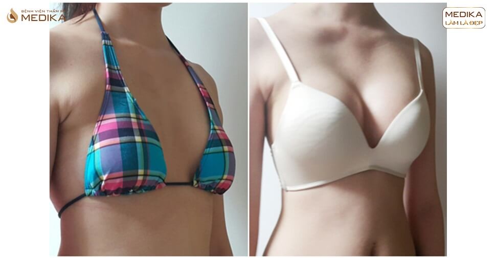 Hình ảnh trước và sau khi thực hiện nâng ngực nội soi tại MEDIKA - Nangngucxe.vn