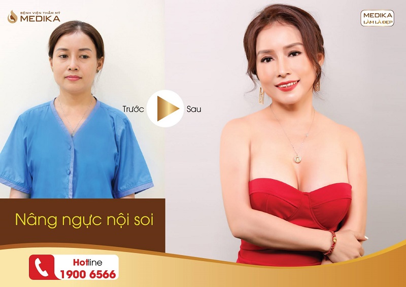 Nâng ngực đẹp phụ nữ nào không thích tại Nangngucxe.vn